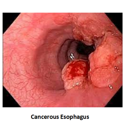 Cancerous Esophagus