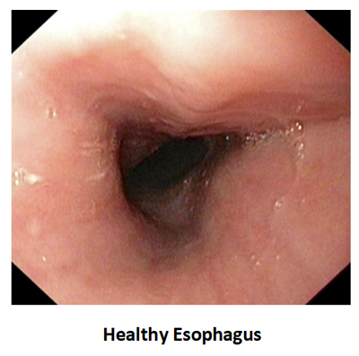 Healthy Esophagus